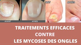 Comment soigner une mycose des ongles [upl. by Yruj]