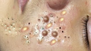 Extreme Blackhead Removal at LNG Skin Care 7214 [upl. by Normi]