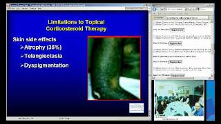 Atopic Dermatitis Eczema [upl. by Sproul]