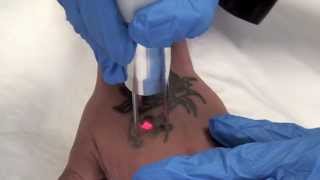 QSwitched NdYAG Tattoo Removal Laser  The Astanza Duality [upl. by Devora147]