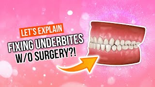 How To Fix An UNDERBITE Without Surgery [upl. by Al]