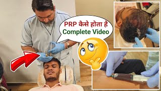 PRP Hair Loss Treatment Before And After Results GFC Hair Treatment Results Before And After Raipur [upl. by Nuawaj]