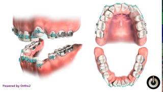 4 First Premolar Extraction for Crowding [upl. by Yalc]