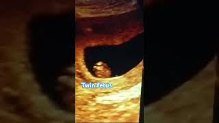 Ultrasound of fetal well being Twin CRL Monochronic amp Monoamnotic youtubeshorts shorts pregnacy [upl. by Rostand]