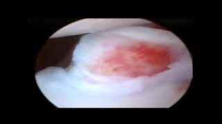 Fragmented Coronoid Process Arthroscopic Movie [upl. by Dranyer633]