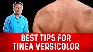 Best Tips for Tinea Versicolor Treatment Skin Fungus – Dr Berg [upl. by Raknahs424]