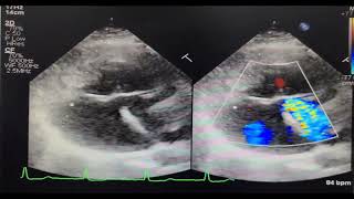 Endocardial Cushion Defect  Rastelli type C [upl. by Elleuqar]