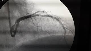 Angioplastia urgente con ROTABLATOR2 [upl. by Jer]