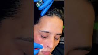 Cosmelan treatment for hyperpigmentation [upl. by Aroled]