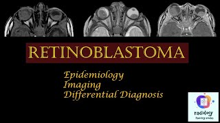 RETINOBLASTOMA Case discussion Epidemiology Imaging and Differential Diagnosis [upl. by Lledniw699]