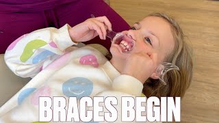 GETTING STARTED WITH BRACES AT AGE 8  SHORTEN BRACES TIME  MOUTH EXPANDER  TOO YOUNG FOR BRACES [upl. by Ettenan]