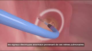 Comment fonctionne l ablation par cathéter [upl. by Anelrihs]