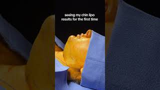 CHIN LIPO BEFORE amp AFTER 🤯 doublechinlipo glowup beforeandafter chinlipo chinliposuction [upl. by Nonrev]