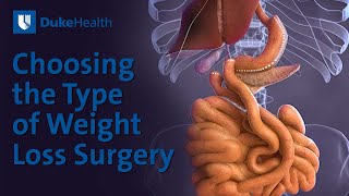 Choosing the Type of Weight Loss Surgery  Duke Health [upl. by Eirehs281]