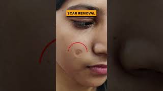 Scar Removal Treatment in Delhi  Scar removal results before and after scar scarremoval scars [upl. by Ereynihc]