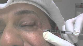 Blepharospasm and Botox Treatment [upl. by Acsecnarf]