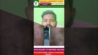 Skin Disease  Tamil  Homoeopathy  Dr Ranjith shorts homoeopathy [upl. by Neras]