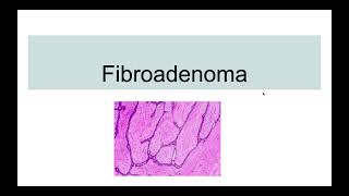 Fibroadenoma [upl. by Neeliak]