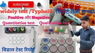 widal test in hindiwidal test practical Qualitative widal test  Quantitative widal test  Typhoid [upl. by Saerdna]