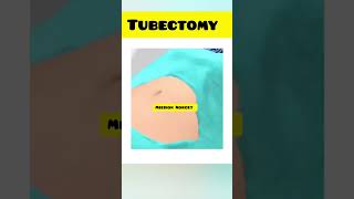 tubectomy animation surgery।।shortsviralshorts [upl. by Sidwell]