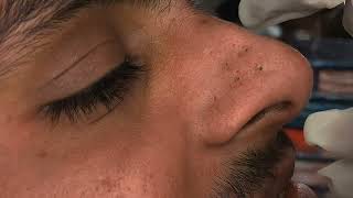 YouTube Blackheads Nose Blackheads poppingblackheads [upl. by Atirehgram921]