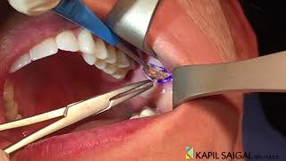 AWAKE Buccal Fat removal [upl. by Areid232]