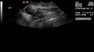 Ultrasound guided fine needle biopsy demonstrating the needle white line sampling the nodule [upl. by Feerahs]