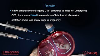 UOG video abstract on chorionic villus sampling in twin pregnancy [upl. by Cheryl212]