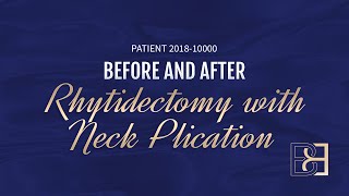 Rhytidectomy Full Facelift Patient 201810000 Before amp After [upl. by Lenno484]