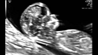 Ultrasound Video Part One 12 Weeks amp 2 Days Its a girl 101512 [upl. by Zora171]