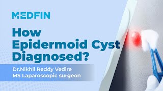 Understanding Epidermoid Cysts Causes Symptoms and Treatment Options [upl. by Crispen488]