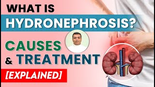 What is Hydro Nephrosis  Causes amp Treatment Explained [upl. by Ainesey100]