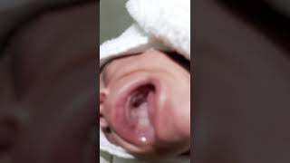 Case 291 what is the most common cause of high arch palate Developmental down syndrome OGT ETT [upl. by Ecam]