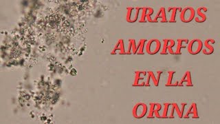 🔥 URATOS AMORFOS EN LA ORINA 🔥 [upl. by Patrizius]