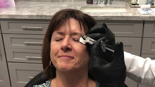 Eyebrow Lift using dermal filler by Dr Nikko [upl. by Alanna]