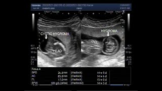 Cystic Hygroma with a pregnancy of about 15 weeks [upl. by Napoleon]