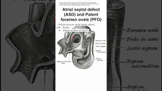 Atrial septal defect ASD and Patent foramen ovale PFO [upl. by Katherin]