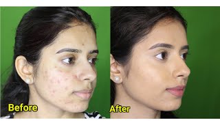 How to cover acne scars with makeup for indian skin  acne prone skin 2018 [upl. by Oxford853]