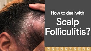 Dealing with Scalp Folliculitis Watch immediately [upl. by Ekalb352]