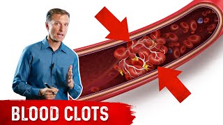 How to Know if You Have a Blood Clot [upl. by Manaker120]