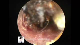 耳內鏡：聚寶盆一樣的外耳道Cornucopia like external auditory canal [upl. by Hazem]