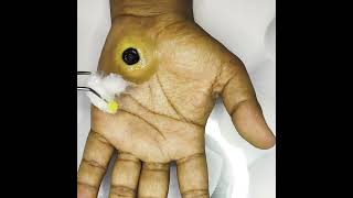 blackheads Botfly Maggot Removal spa doctor pimpleremoval [upl. by Inalaeham184]