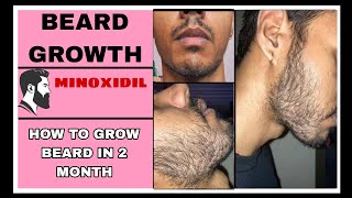 BEARD GROWTH  COMPLETE JOURNEY KE BAAD KYE KARNA HAI [upl. by Lrak]