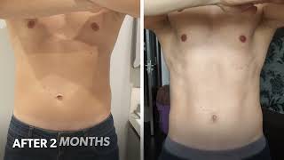 SculpSure Before amp After 1 session [upl. by Reiner]