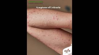 Natural Urticaria Relief Ayurvedic Remedies for Healthy ItchFree Skin 🌿✨ [upl. by Ylrebmyk819]