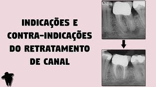 DE 12 Indicações e Contra Indicações da Apicectomia e do Retratamento Endodôntico [upl. by Aharon]