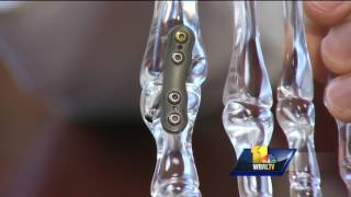 Video New procedure helps treat big toe arthritis [upl. by Holcomb]