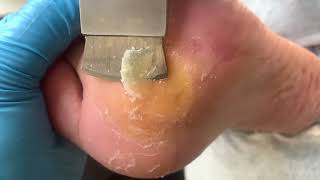 Callus removal from feetampFoot scraping dead skin【Xiao Yan pedicure】stress 71 [upl. by Marron]