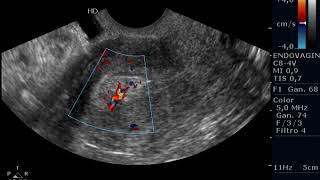 Ecografia Transvaginal de Polipo endometrial con Doppler Color [upl. by Gyatt]