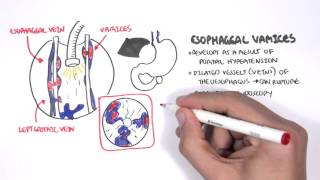 Upper GI Bleed Causes Overview [upl. by Tnecnivleahcim397]